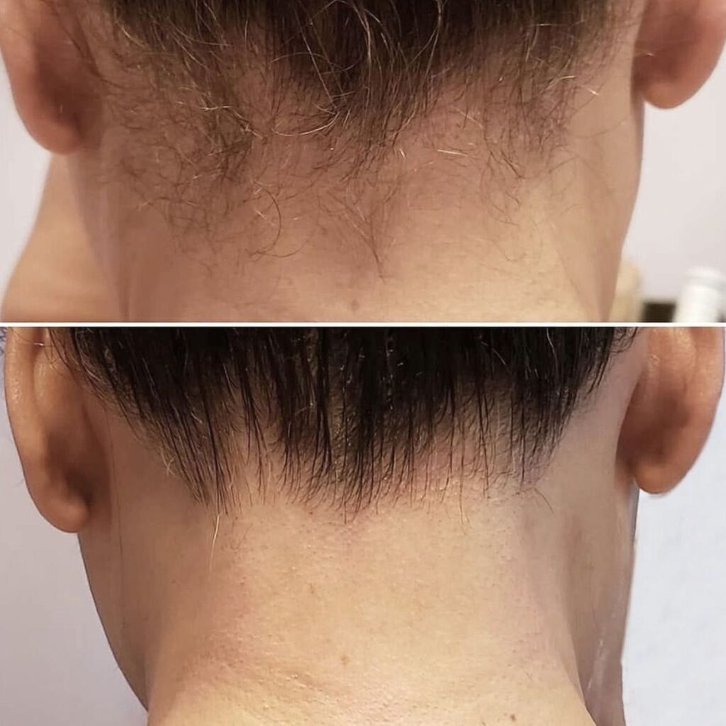 DEPILACJA LASEROWA 11