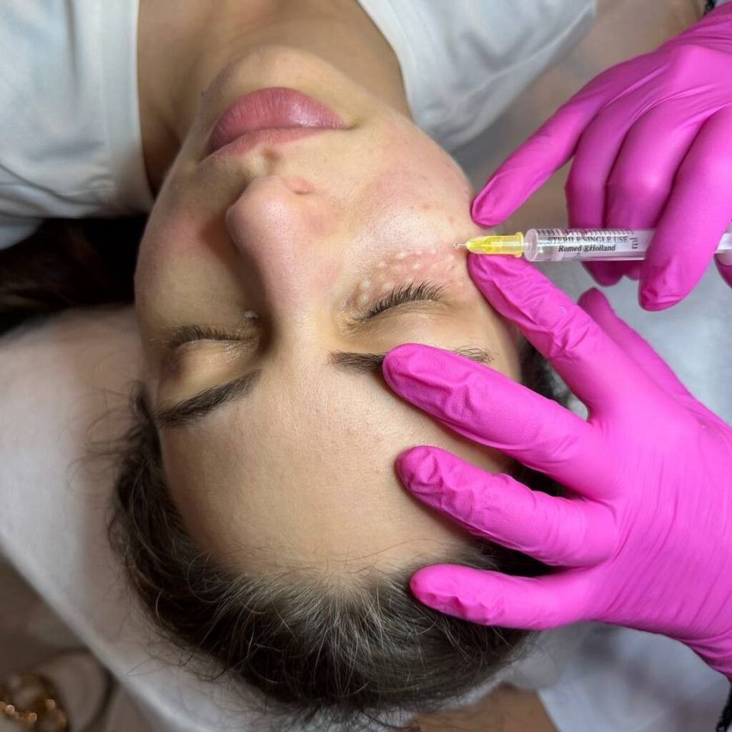 MEZOTERAPIA 9