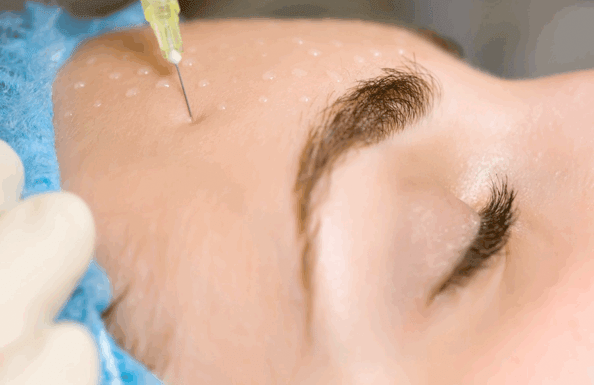MEZOTERAPIA 3